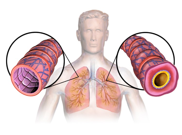hình ảnh đường thở viêm nhiễm