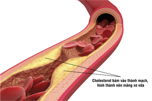 mỡ máu cao khiến nguy cơ xơ vữa động mạch