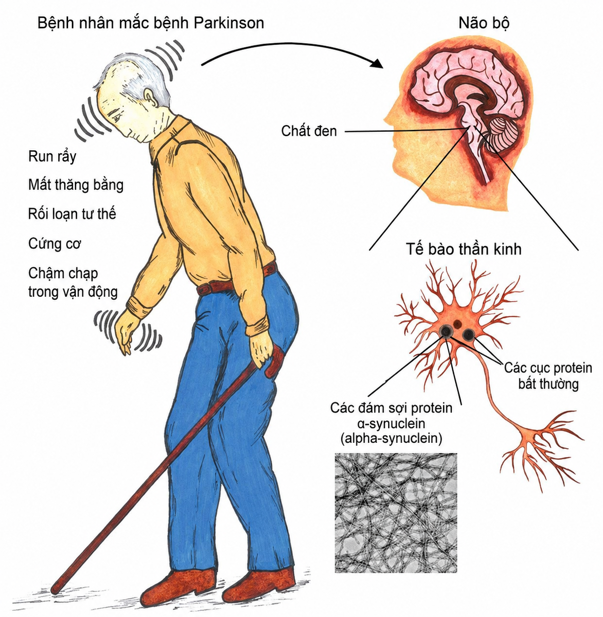 Bài thuốc mới hỗ trợ điều trị bệnh Parkinson, run tay chân ở người già hiệu quả